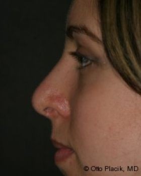 Rhinoplasty - Before & After - Dr. Placik