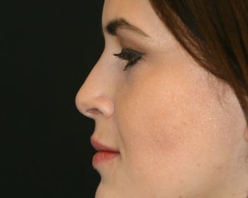 Rhinoplasty - Before & After - Dr. Placik