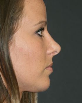 Rhinoplasty - Before & After - Dr. Placik