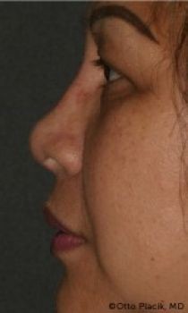 Non-Surgical Rhinoplasty - Before & After - Dr. Placik