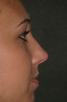 Non-Surgical Rhinoplasty - Before & After - Dr. Placik