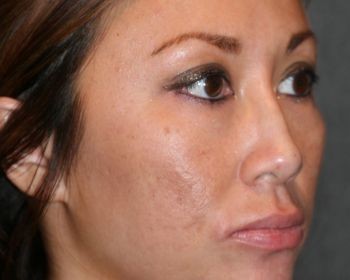 Non-Surgical Rhinoplasty - Before & After - Dr. Placik