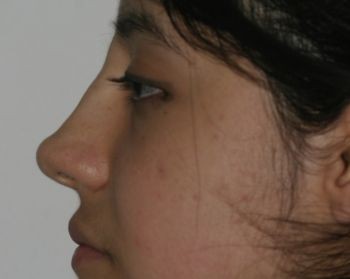 Non-Surgical Rhinoplasty - Before & After - Dr. Placik