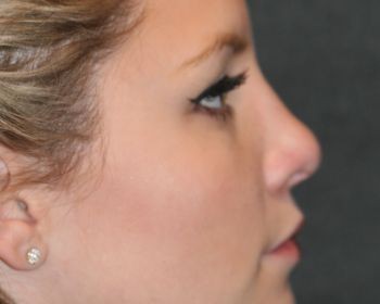 Non-Surgical Rhinoplasty - Before & After - Dr. Placik