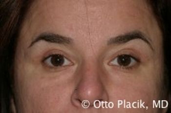 Eyelid Surgery - Before & After - Dr. Placik