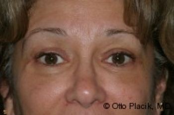 Eyelid Surgery - Before & After - Dr. Placik