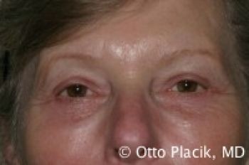 Eyelid Surgery - Before & After - Dr. Placik