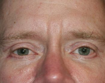 Eyelid Surgery - Before & After - Dr. Placik