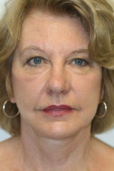 Face Lift - Before & After - Dr. Placik