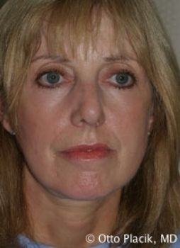 Face Lift - Before & After - Dr. Placik