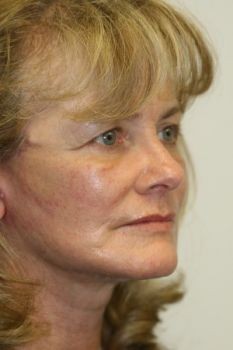 Face Lift - Before & After - Dr. Placik