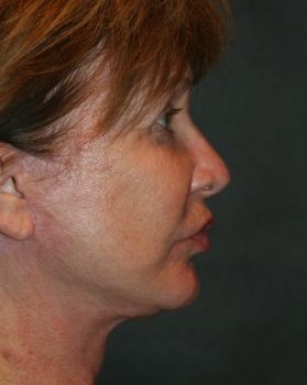 Face Lift - Before & After - Dr. Placik