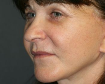 Face Lift - Before & After - Dr. Placik