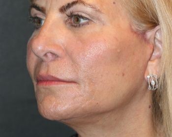 Face Lift - Before & After - Dr. Placik