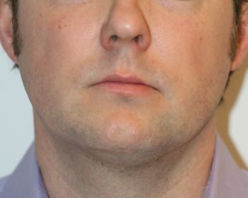 Buccal Fat Extraction - Before & After - Dr. Placik