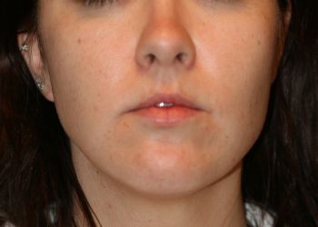 Buccal Fat Extraction - Before & After - Dr. Placik