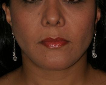 Buccal Fat Extraction - Before & After - Dr. Placik