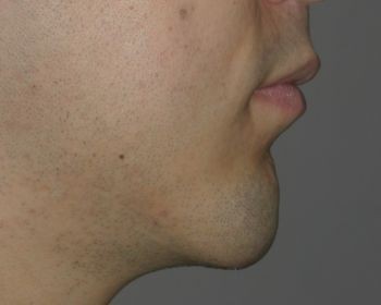 Buccal Fat Extraction - Before & After - Dr. Placik