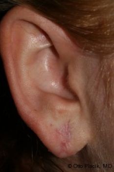 Earlobe Repair - Before & After - Dr. Placik