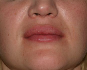 Lip Enhancement - Before & After - Dr. Placik