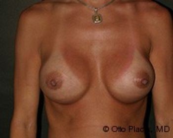 Before & After Breast Augmentation Gallery - Before & After - Dr. Placik