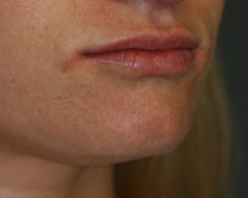 Lip Enhancement - Before & After - Dr. Placik