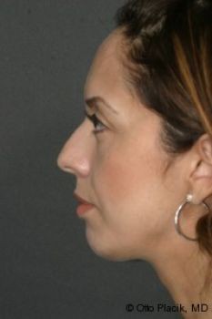 Chin Surgery - Before & After - Dr. Placik