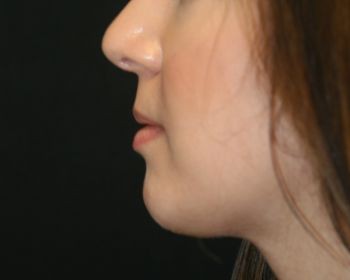 Chin Surgery - Before & After - Dr. Placik