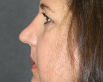 Injectable Filler - Before & After - Dr. Placik