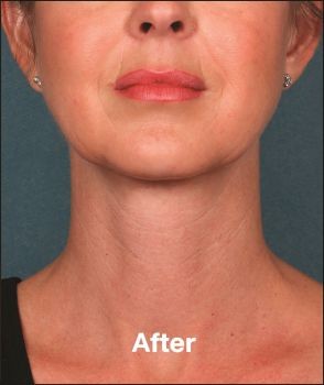 Kybella - Before & After - Dr. Placik