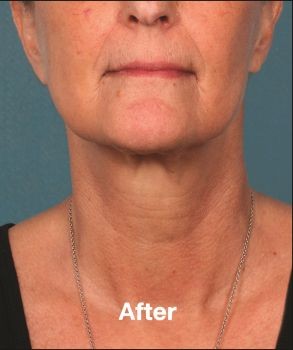 Kybella - Before & After - Dr. Placik