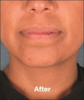 Kybella - Before & After - Dr. Placik