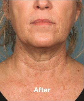 Kybella - Before & After - Dr. Placik