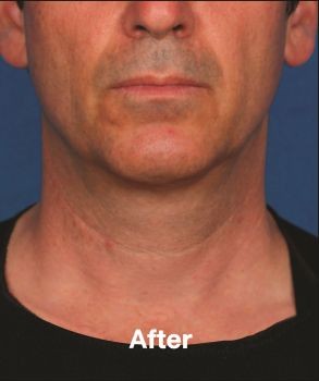 Kybella - Before & After - Dr. Placik