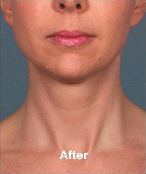 Kybella - Before & After - Dr. Placik