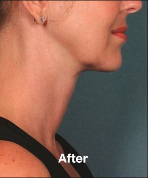 Kybella - Before & After - Dr. Placik