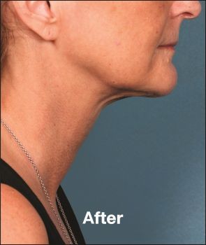 Kybella - Before & After - Dr. Placik