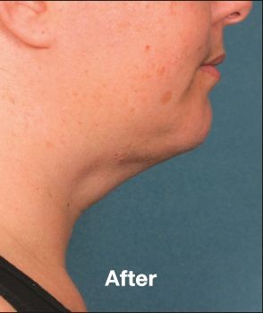 Kybella - Before & After - Dr. Placik