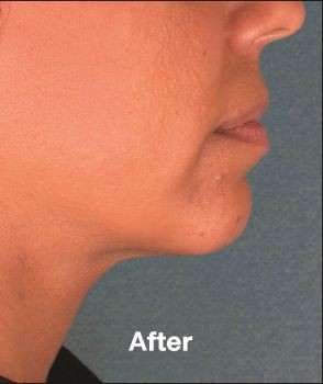 Kybella - Before & After - Dr. Placik