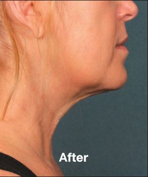 Kybella - Before & After - Dr. Placik