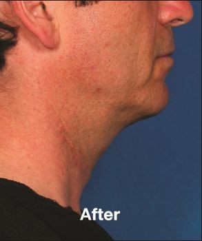 Kybella - Before & After - Dr. Placik