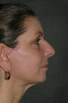 Lipoinjections to Various Facial Areas - Before & After - Dr. Placik