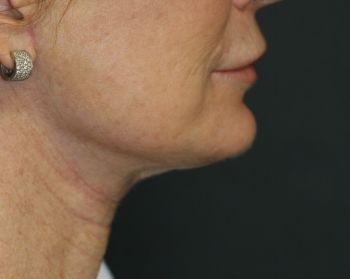 Lipoinjections to Various Facial Areas - Before & After - Dr. Placik