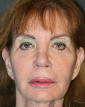 Vampire Facelift - Before & After - Dr. Placik