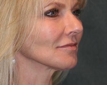 Vampire Facelift - Before & After - Dr. Placik