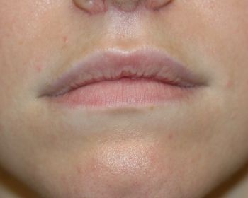 Lip Lift - Before & After - Dr. Placik