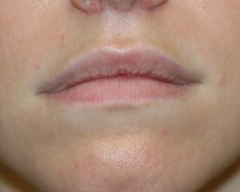 Lip Lift - Before & After - Dr. Placik