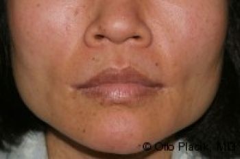 Lip Lift - Before & After - Dr. Placik