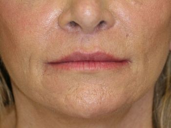 Lip Lift - Before & After - Dr. Placik