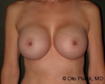 Before & After Breast Augmentation Gallery - Before & After - Dr. Placik